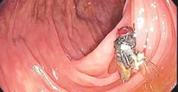 মানুষের পেটে অক্ষত জীবন্ত মাছি, অবাক ডাক্তাররা