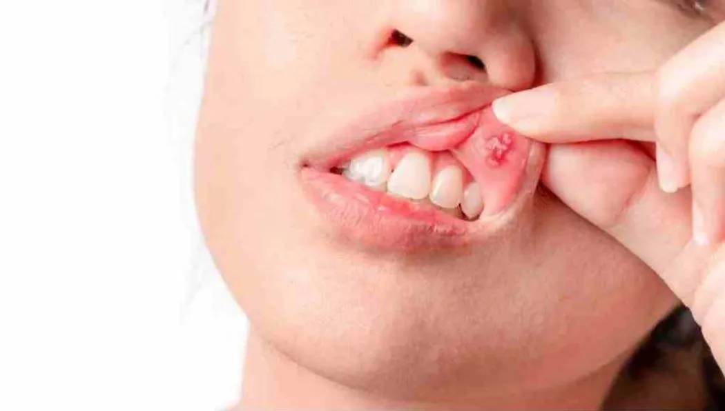 শীতে ঠোঁট ও মুখে ঘা ঘরোয়া উপায়েই মিলবে সমাধান