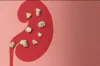 কিডনিতে পাথর হওয়ার ঝুঁকি কমায় যেসব ফল