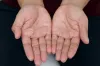 গরমে হাতের চামড়া উঠছে? কারণ জানলে অবাক হবেন, সমাধানও আছে